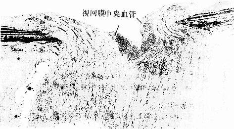 人眼球视网膜的视神经乳头