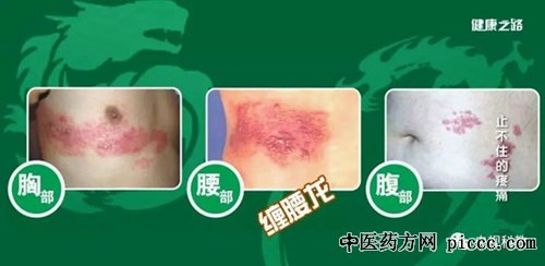 安建雄,止不住的痛苦,带状疱疹,三叉神经痛:20180719健康之路视频