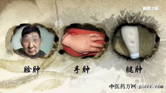 孔薇,中医治水肿,桑枝棒消肿法:20180723健康之路视频