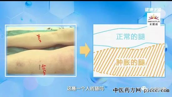 健康之路20180807:刘鹏,丧命的腿肿,深静脉血栓,肺动脉栓塞