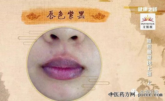 健康之路20180810:杨中,防癌防血瘀,血瘀体质易患癌,防癌方