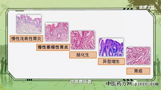 健康之路20180822:宋志强,胃炎到胃癌,幽门螺杆菌检测法