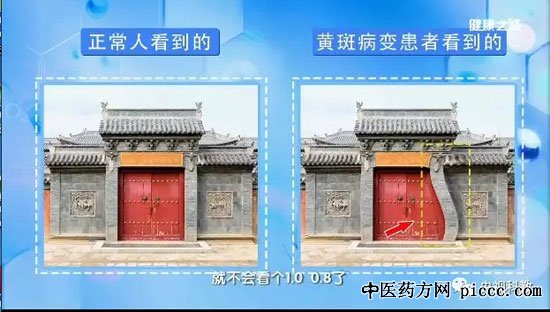 健康之路20180902:魏文斌,眼部疾病黄斑病变,视网膜脱落