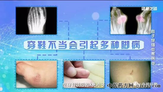 健康之路20180906:张建中,鞋子穿错也闯祸,足跟痛,足弓塌陷