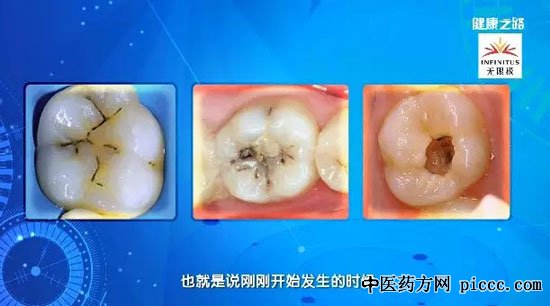 健康之路20180920:刘怡,人老也能不掉牙,牙周病,龋齿,有一口好牙