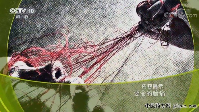 健康之路20180925:刘如恩,三叉神经痛,要命的脸痛