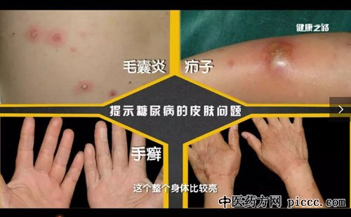 健康之路20181011:朱学骏,毛囊炎警惕糖尿病,脸黄瘤提示高血脂