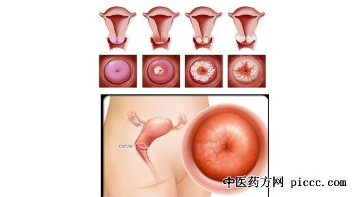 饮食养生汇20181109:吴向红,女性隐性杀手宫颈癌,宫颈癌不可怕