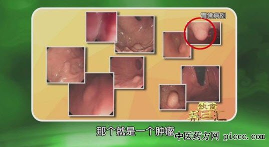 饮食养生汇20181217:汪正芳,看不见的肿瘤,胃癌,胃肠道的癌症