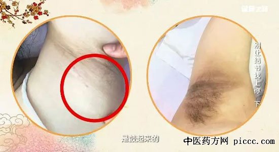健康之路20190425:马立新,别让结节找上你,拍打治疗身上的鼓包