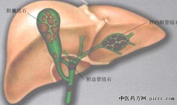 健康之路20190506:黄永辉,姚炜,胆囊发炎要切除吗,胆管结石的医治