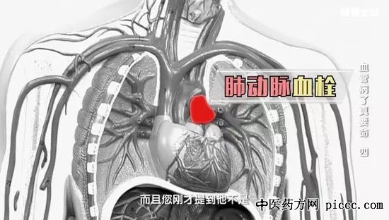 健康之路20190616:刘鹏,久坐都会导致下肢腿肿,深静脉血栓