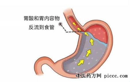 健康之路20190628:刘殿刚,胃食管反流会伪装,胃食管反流治疗三部曲
