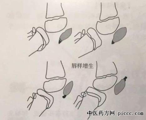 健康之路20190709:张虹,髌骨软化症自测办法,骨性关节炎的表现