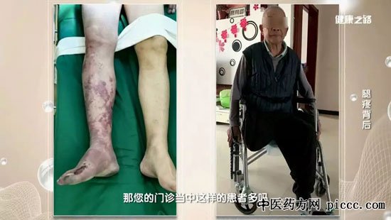 健康之路20191118:足背动脉测验,冯海,雷荣强,动脉硬化闭塞症