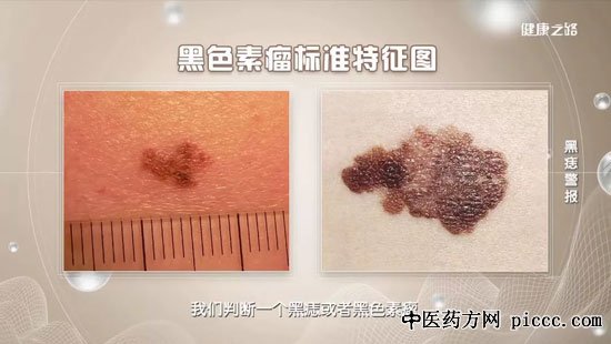 健康之路20191201:王宝玺,黑痣是怎么回事,黑色素瘤,黑痣恶变