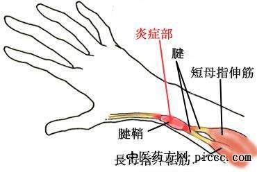 健康之路20191217:李忠哲,腱鞘炎的风险健康测验,腱鞘炎防治法