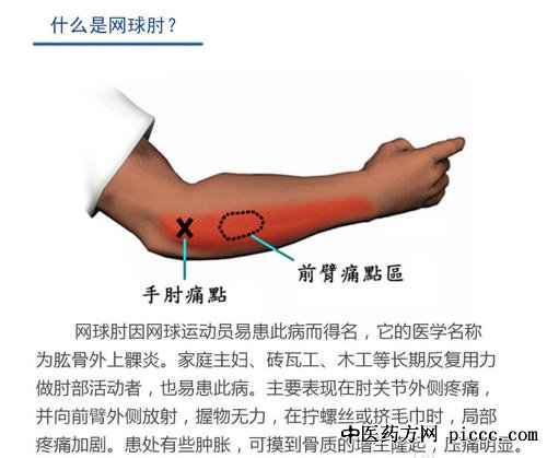 健康之路20191218:张道俭,什么是网球肘,肘部疼痛怎么办,网球肘