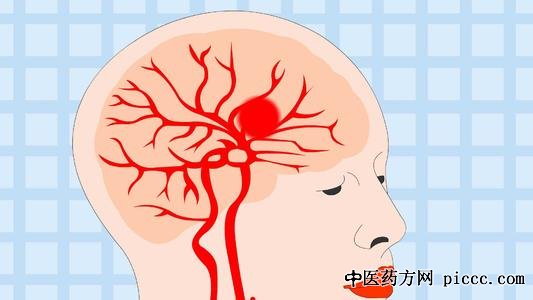 健康之路20200220: 杨新健,诱发脑动脉瘤原因,颅内动脉瘤出血