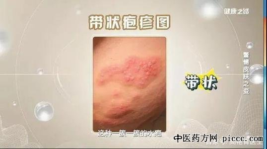 健康之路20200813:警惕皮肤之变,高艳青,必须了解的带状疱疹病毒疣
