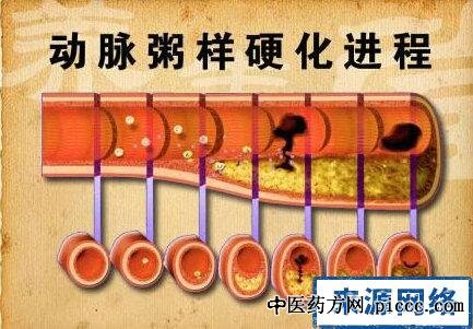 养生堂20200820:破解动脉硬化的密码,余秋平,通脉方配伍,冠心病