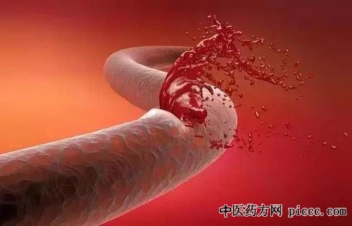 养生堂20201216:赵性泉,脑出血早发现,脑表面的出血的蛛丝马迹