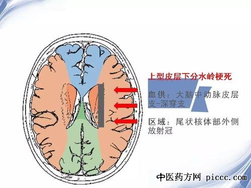 养生堂20201224:赵元立,脑梗死的特点,不良因素是分水岭梗死高危