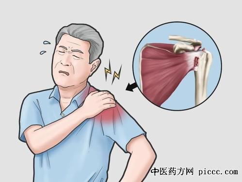 杨晋才,肩痛是谁惹祸,任世祥,致残的肩病与肩周炎