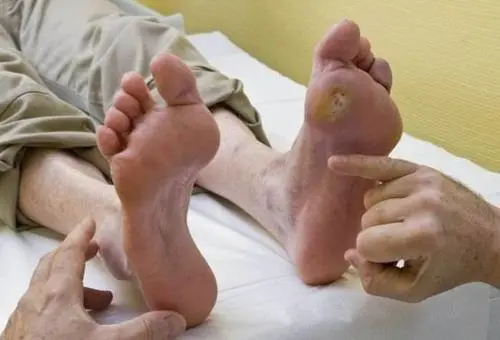 养生堂20210710:张明珠,谁在吃你的骨髓,骨髓保卫战,糖尿病足