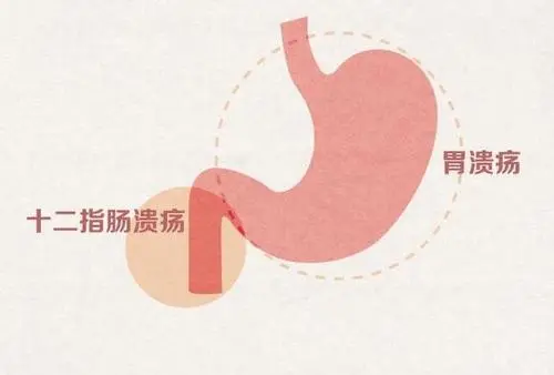 养生堂20210720:李鹏,孟凡冬,胃溃疡癌变,胃癌,癌的溃疡化