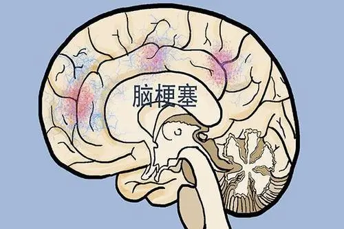 养生堂20210804:缪中荣,夏季脑梗,中风识别信号,中风