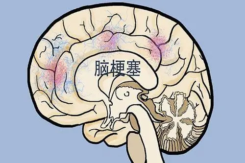 健康之路20210908:缪中荣,防治脑梗要三快,识别症状快,送医时间快