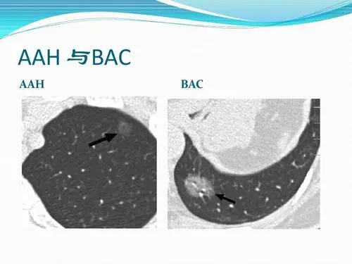 健康之路20210909:张毅,肺结节,什么是磨玻璃结节,肺部结节分情况