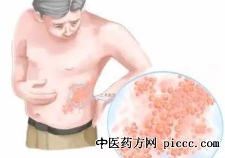 健康之路20211011:李厚敏,带状疱疹,带状疱疹的疼痛特点与治疗