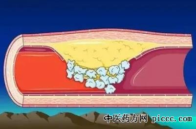 养生堂20211026:血管钙化自测,刘巍,陈佳,血管年纪计算公式