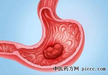 健康之路20211103:周爱萍,年轻人中的胃癌,习惯导致了胃癌的产生