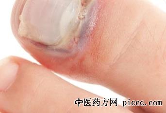 健康之路20211108:何焱玲,甲沟炎,甲沟炎其实都是自己剪出来的