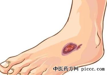 健康之路20211113:潘琦,糖尿病足溃疡,糖尿病足溃疡的预警与预防