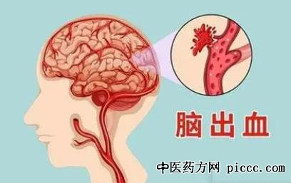 ÑøÉúÌÃ20211111:ºéèº,ÄÔÒçѪµÄÓÕ·¢ÒªËØ,ÄÔѪ¹Ü»ûÐÎ,Í·Í´ÄÔ³öѪ