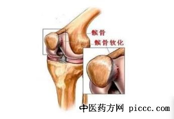 养生堂20211122:王卫国,自测髌骨类型,髌骨磨损,锻炼护关节,丁冉