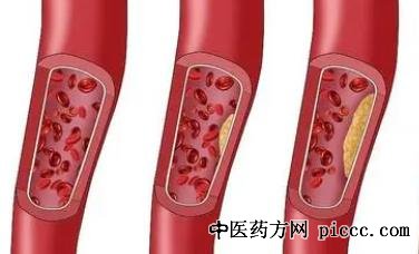 养生堂20211127:刘梅颜,伤害心血管的方式,光滑血管也要命