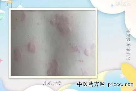 健康之路20211205:张苍,祛湿邪,荨麻疹,湿疹的致病原因,气态湿邪