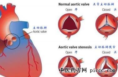 养生堂20211223:潘湘斌,张戈军,正常主动脉瓣膜VS主动脉瓣反流