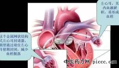 养生堂20220106:徐东,心脏也有耳朵,给左心耳筑堤坝,防中风,血栓