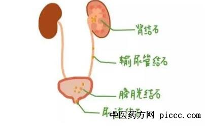 健康之路20220106:尿频,肾结石,结石也会丢了肾,医生的谨遵医嘱