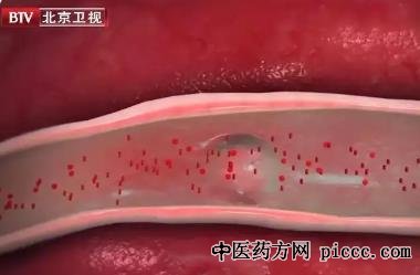 健康之路20220209:叶志东,血管爆裂之前的症状与原因,血管爆裂