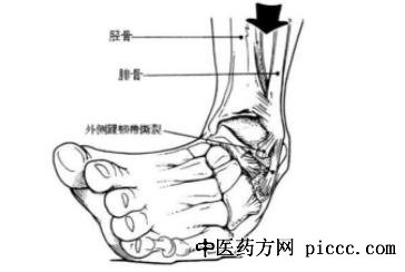 健康之路20220215:踝关节受损怎么办,如何避免运动中踝关节受损