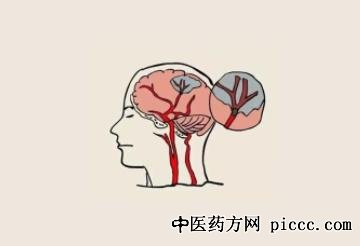 养生堂20220309:马青峰,快速识别脑卒中,脑卒中,脑梗,溶栓治疗