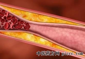 健康之路20220310:叶志东,颈动脉狭窄怎么办,动脉硬化粥样性斑块