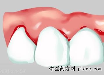 健康之路20220315:记忆力差,牙龈出血,身体出现小红点需警惕血液病